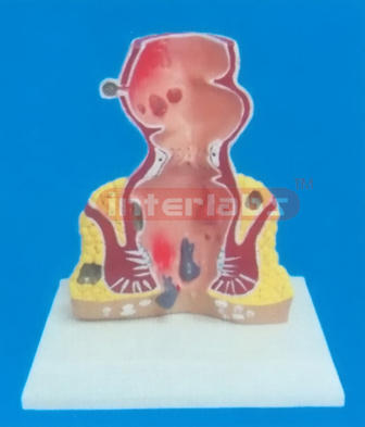 DESK-TYPE, COMMOM PATHOLOGIES MODEL OF RECTUM